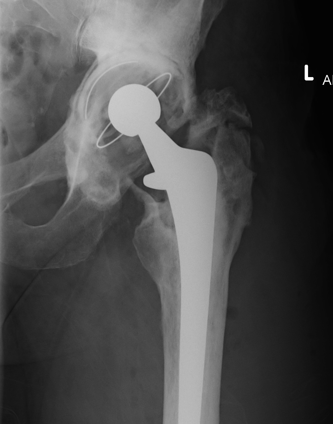 Infected THR progressive bone loss and lysis